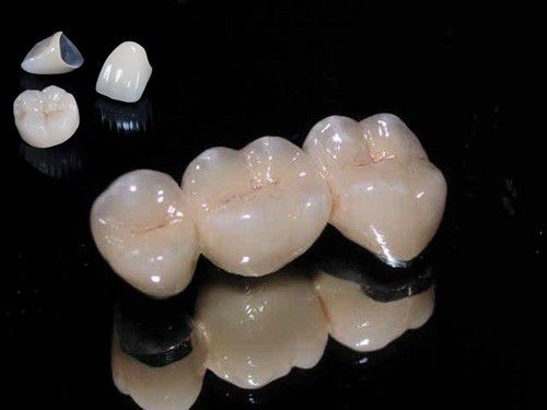 Răng sứ kim loại Mỹ