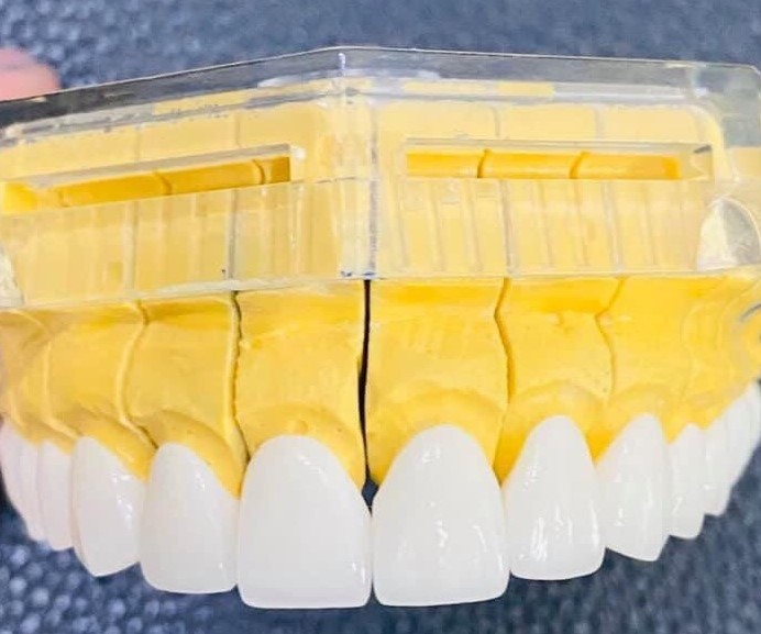 Răng Sứ Argenz Ultra